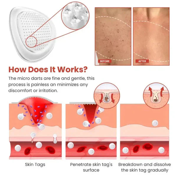 Skin Tag Remover Patch